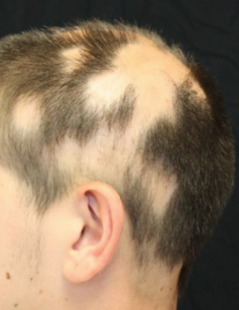 Alopecia Areata Causes and Symptoms
