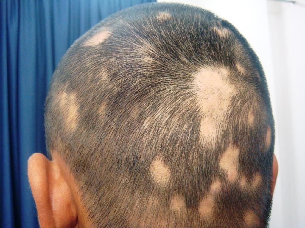 How to Treat Alopecia Areata?